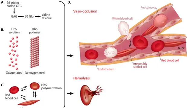 Figure 3: Pathophysiology of Sickle Cell Disease. (A) Point mutation in SCD. (B) Polymerization of  hemoglobin  S  (HbS)  under  deoxygenation