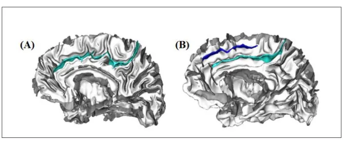 Figure 6 : motifs sulcaux du cortex cingulaire antérieur, (A) cerveau avec un sillon cingulaire : motif  symétrique  (bleu  clair),  (B)  cerveau  avec  sillon  cingulaire  et  un  sillon  para-cingulaire  :  motif  asymétrique (bleu foncé)