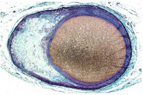 Figure  4:  Human  Coronary  Artery  with  Compensatory  Enlargment,  (adapted  from  S
