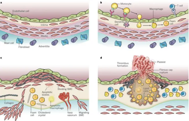 Figure  5:  Stages  in  the  development  of  atherosclerotic  lesions,  (A)  The  normal  artery  contains  3  layers:  tunica  intima,  media,  adventitia
