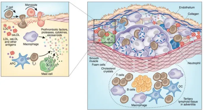 Figure 6: Immune components of the atherosclerotic plaque, Several types of cells of the  immune  response  are  present  in  the  atheroma;  these  include:  macrophages,  T  cells,  dendritic  cells,  and mast cells