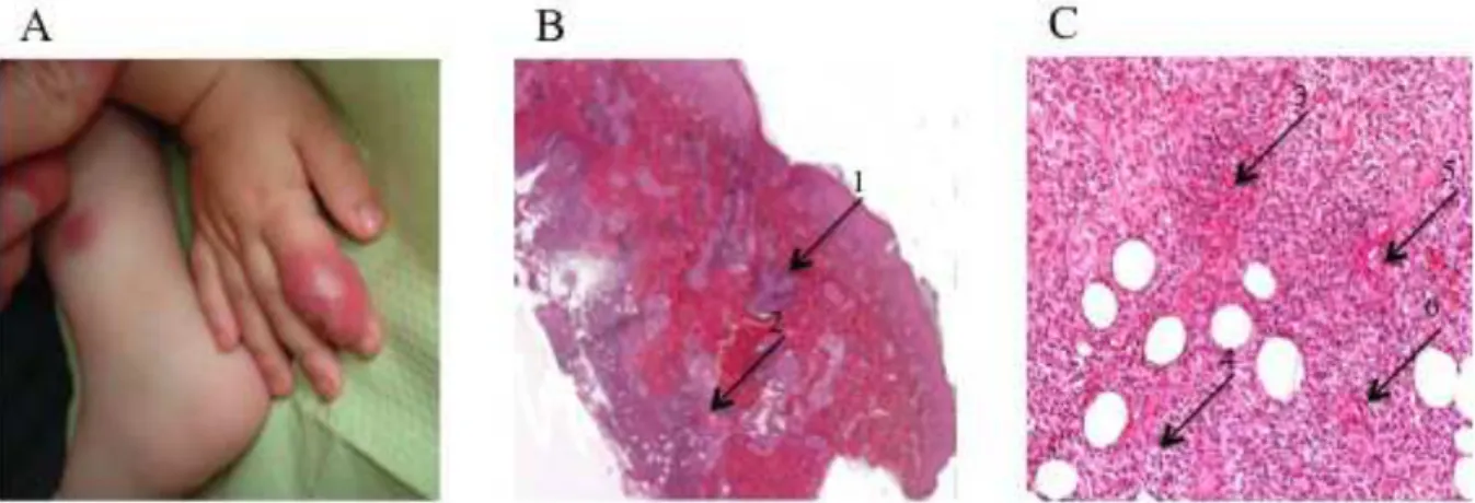 Figure 18. Macroscopic and microscopic aspects of sterile skin and joint inflammation
