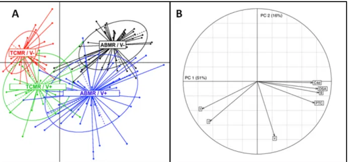 Figure  11:  Analyse  en  composantes  principales  (ACP)  des  patients  transplantés  rénaux porteurs d’un diagnostic de rejet aigu d’allogreffe