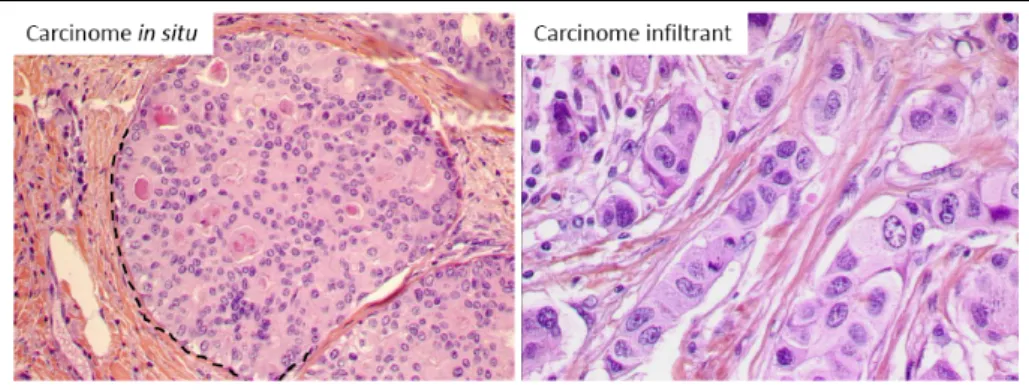 Figure    5:   Tumeur  du  sein  de  type  in  situ  ou  infiltrant  sans  autre  spécificité.  Dans  le  cas 