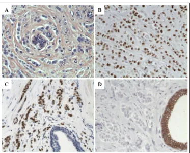 Figure  23:  Caractérisation  phénotypique  des  ILC.  Les  cellules  carcinomateuses  sont  des 