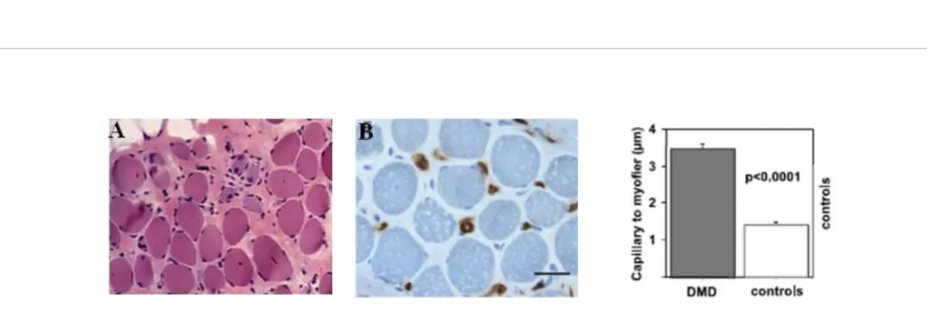 Figure  12:  Vascular  changes  in  DMD.  (A)  Grouped  necrotic  myofibers  (B)  There  was  a  highly  significant 