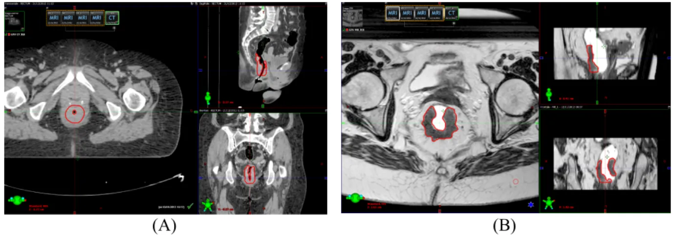 Figure 4. Délinéation d’une tumeur du rectum sur scanner (A) et IRM fusionnée (B) 