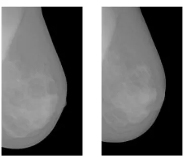 Figure 1.3 – Série temporelle d’une vue médiolatérale oblique du   sein gauche d’une patiente à t 0  et t 0  + 1 an 
