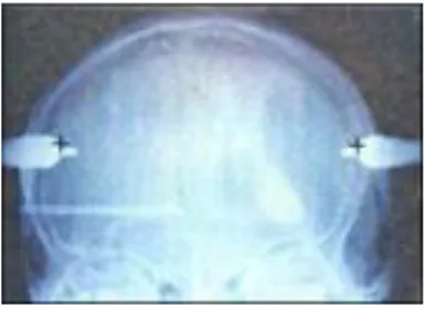 Figure 2.13 - Exemple de points de repère extrinsèques sur une radiographie du crâne [Tro08] 