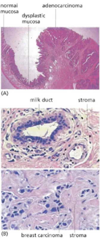 Figure 1.1 – Deux exemples de tissus contenant des cellules tumorales : dans (A), des cellules d’intestin sont organisées dans la gauche de la coupe, dérangées (en état dysplasique) au milieu et tout à fait tumorales (un adénocarcinome) sur la droite