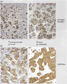 Figure 1.3 – Des métastases sont observées dans le cerveau d’un patient, originellement atteint d’un cancer du sein