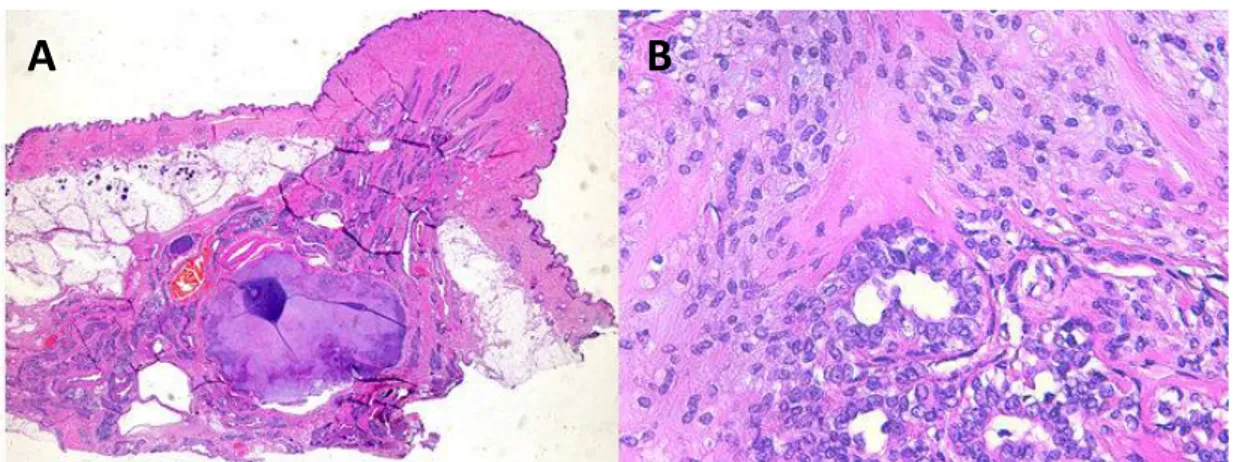 Figure 6: Adénome mammaire complexe. (A) adénome mammaire complexe dans le tissu  glandulaire mammaire sous le mamelon; (B) : association de deux composantes, l’une épithéliale et 