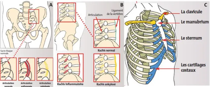 Figure 1 – Représentations des atteintes articulaires axiales dans la SpA ; d’après Dougados et al