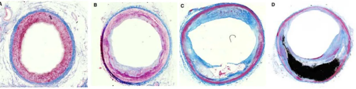 Figure 2-4 : Coupe transversale représentative de différents types de plaques d’athérosclérose    A initiale, B intermédiaire, C avancé, D mature  (Hallow et al., 2009)
