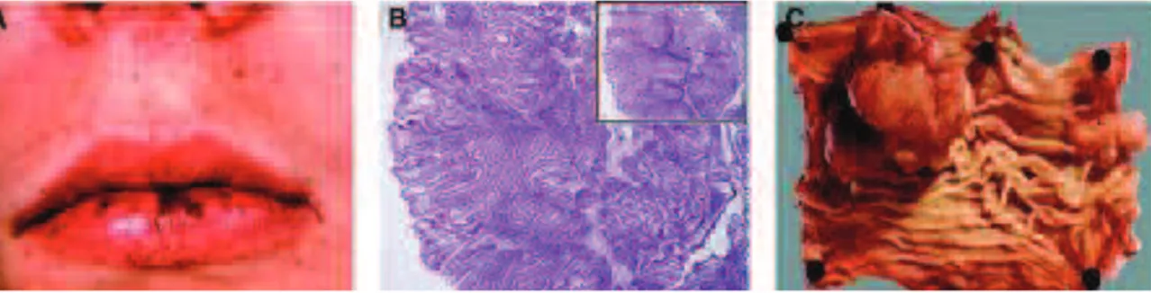 Figure 1: Caractéristiques cliniques du PJS. A: Hyperpigmentation péri-orale. 