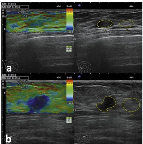 Figure 2-4: Élastographie ultrasonore de tumeurs du sein. (a) Tumeur bénigne (adénofibrome)