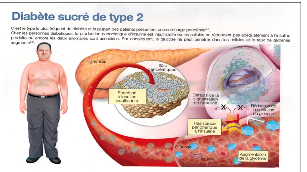 Figure 3. Diabète sucré de type 2 (Fauci, A.S., et al., 2008)