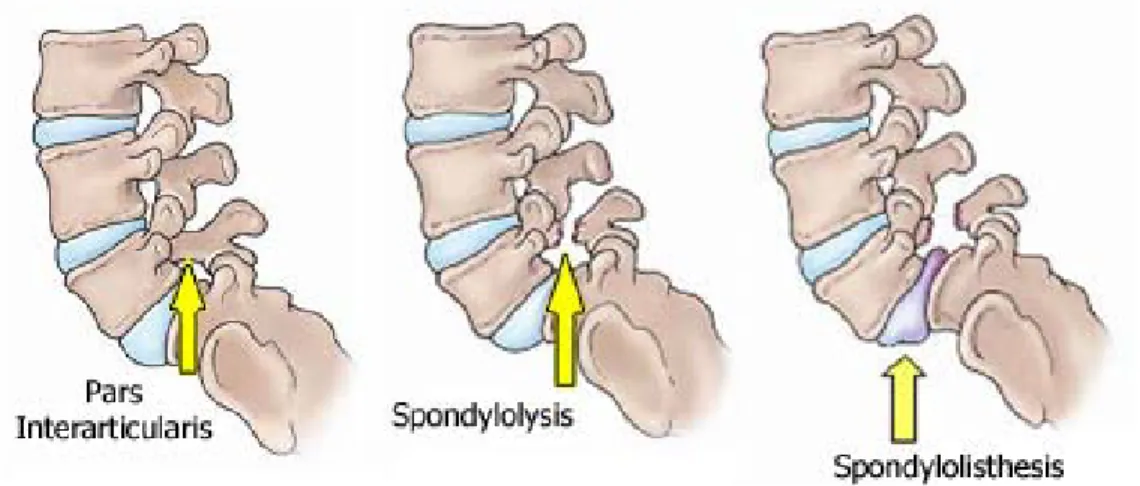 Figure 1-5 : Schematic representation of Spondylolisthesis and Spondylolysis (obtained on 22  June 2011 from  http://orthoinfo.aaos.org/topic.cfm?topic=a00053 ) 