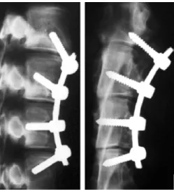 Figure 1-8 : Screws and ligaments inserted at different levels between vertebral bodies (Newton  et al., 2005) 