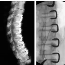 Figure 1-9 : Staples implanted at different levels between vertebral bodies: left panel (Wall et al.,  2005) and right panel (Guille et al., 2007)