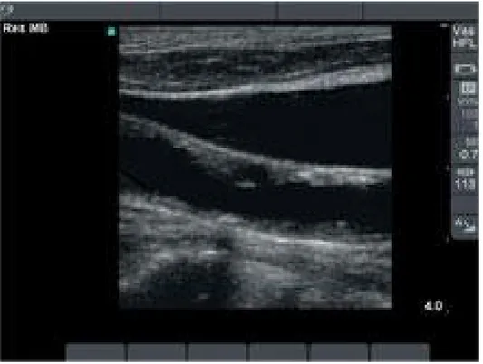 Figure 2-8. Veine jugulaire et artère carotide visualisées sur une machine d'ultrasonographie [47].