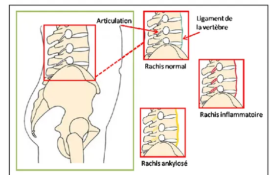 Figure 3. Schéma du rachis normal, inflammatoire et ankylosé. 