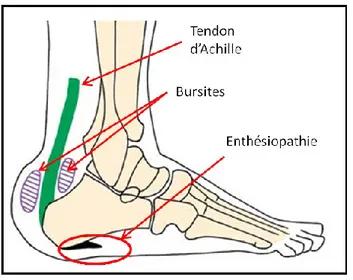 Figure 7. Schéma d’une enthèse calcanéenne. 