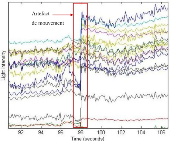 Figure 1.5  Artefact de mouvement lors du mouvement d'un sujet Artefact  