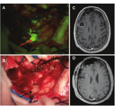 Figure 1.5 – Intraoperative view during resection of a right frontal glioblastoma; the 5-ALA fluorescent tumor