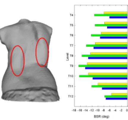 Figure 4.8 Left: Double major curve scoliotic patient (preoperative geometry). Right: BSR indices measured on the actual postoperative trunk, the simulated trunk and the preoperative trunk surface