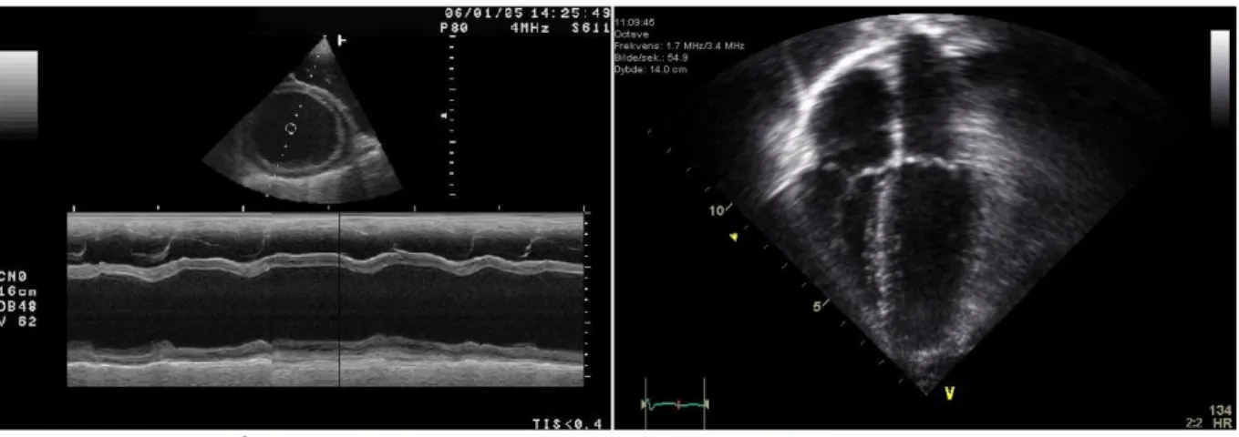 Figure 1.9 - Images échocardiographiques : mode M (à gauche); mode à deux dimensions (à  droite) - tiré de wikimedia 