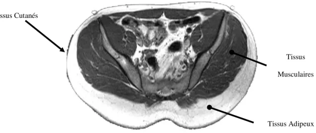 Figure 1.3 : Coupe axiale d’un fessier humain obtenue par résonance magnétique et présentant les  trois couches de tissus mous du fessier 