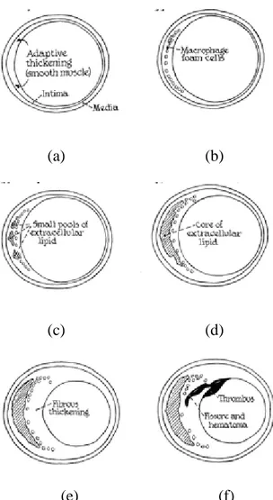 Figure 1.7 Atherosclerosis: schematic view of lesions types [27]. Coronary artery at  lesion-prone location (a), type II lesion (b), type III or preatheroma (c), type IV or 