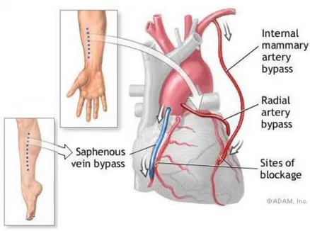 Figure 1.19: Coronary artery bypass graft: saphenous vein, radial artery and internal  mammary artery bypass example [51]
