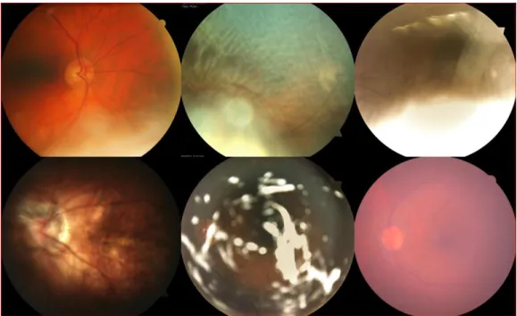 Figure 3-1. Examples of bad quality retinal images 