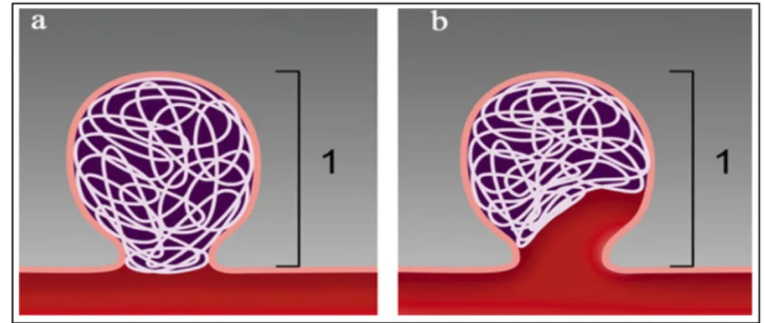 Figure 7: a) Occlusion anévrysmale complète. b) Compaction de coils et récurrence anévrysmale