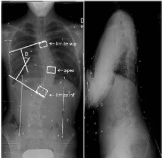 Figure 2.5 Radiographie du dos d’un patient. Mesure de l’angle de Cobb (image gauche) à partir des vertèbres limites.