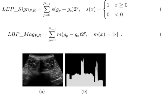 Figure 3.5 Vertebral ultrasound image (left) and binarized image based on rupture point detection (right).