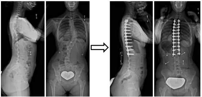 Figure 1-14 : Radiographies sagittale et frontale préopératoire (gauche) et postopératoire (droite)  d'une colonne vertébrale atteinte de scoliose