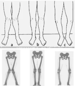 Figure  3.6.  Illustration  de  trois  types  de  désalignement  autour  du  genou  dans  le  plan  frontal  (images du haut) et de leur effet sur le squelette (images du bas)