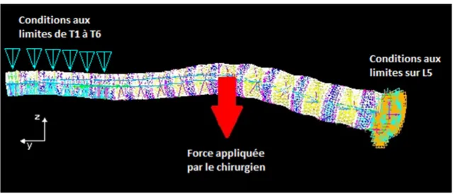 Figure 3-8 : Application d’une force pré-instrumentation par le chirurgien.  Dans cet exemple, la vertèbre apicale est T6