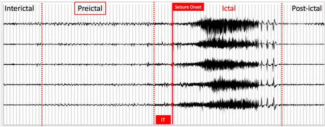 Figure 1.4 Five-channels iEEG illustrating typical epileptic brain states; IT: intervention time  Conceptually, any intervention based on seizure detection is faced with the problem that for  most patients, overt clinical manifestations are already present