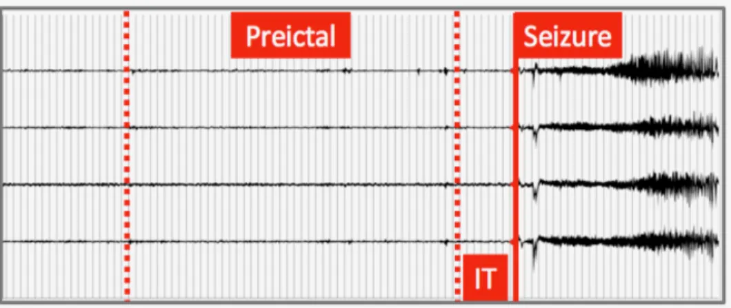 Figure 4.3 Four-channel iEEG recording showing preictal time and IT 