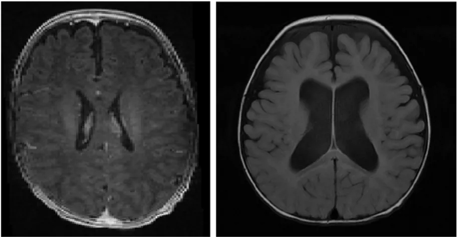 Figure 2.3 Images IRM des ventricules de patients (première cohorte du projet). À gauche le patient 2 avec un taille ventriculaire normale, à droite un cas pathologique d’hydrocephalie et de ventriculomégalie sévère.