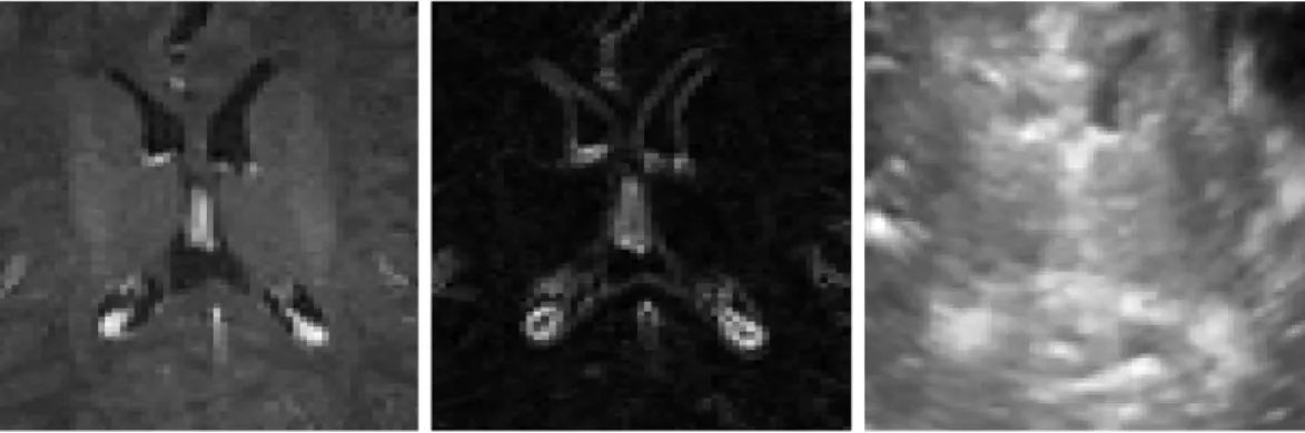 Figure 2.8 Images des ventricules pour un patient de la première cohorte. À gauche l’image IRM, au milieu le gradient de l’IRM et à droite l’image échographique.