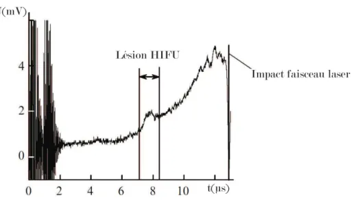 Figure III.1 – Signal photoacoustique détecté dans un échantillon de foie de porc brûlé par ultrasons foca- foca-lisés (HIFU) : longueur d’onde du laser d’illumination de 1064 nm, et détection acoustique large-bande [50 kHz - 2 MHz]