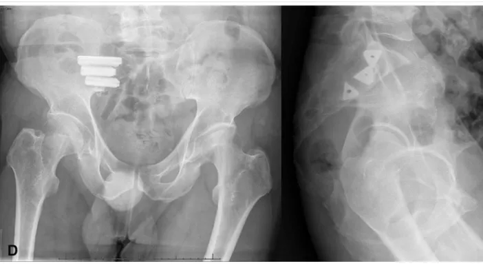 Figure  13  :  Radiographies  postéro-antérieure  et  latérale  post-opératoires  –  CMI  avec  iFuse™