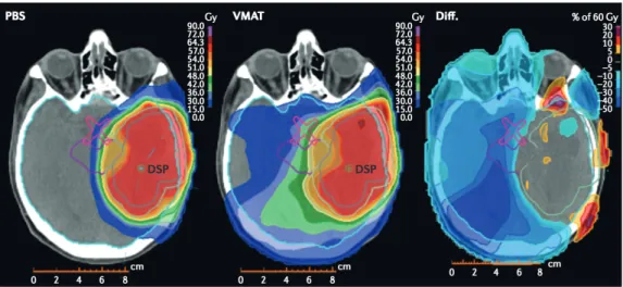 Figure 1.6: Dose plans for a high-grade glioma in proton therapy using Pencil Beam Scanning delivery method (left) and in photon RT delivered with a IMAT (centre)