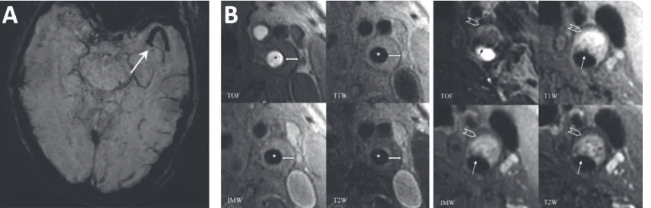 Figure 6. Exemples illustrant l’optimisation des séquences d’IRM pour la visualisation directe du  thrombus et de la plaque vulnérable