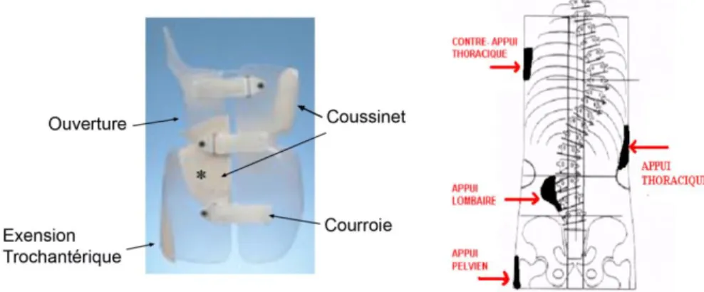 Figure 1.8: Le corset de Boston (Emans, 2003) 